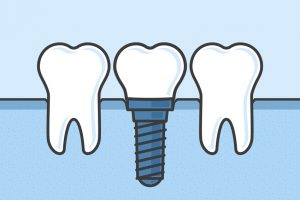 dental implants