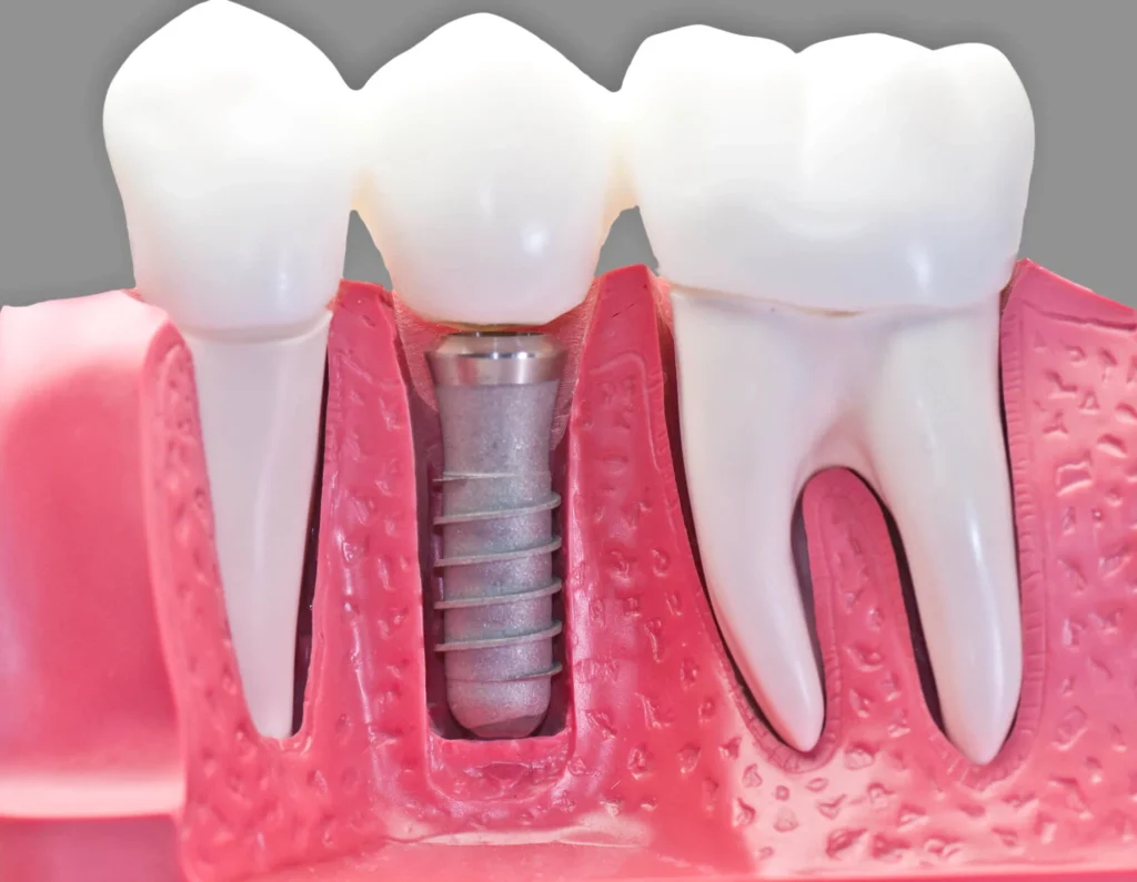 Dental model demonstrating dental implants in Panama City FL.