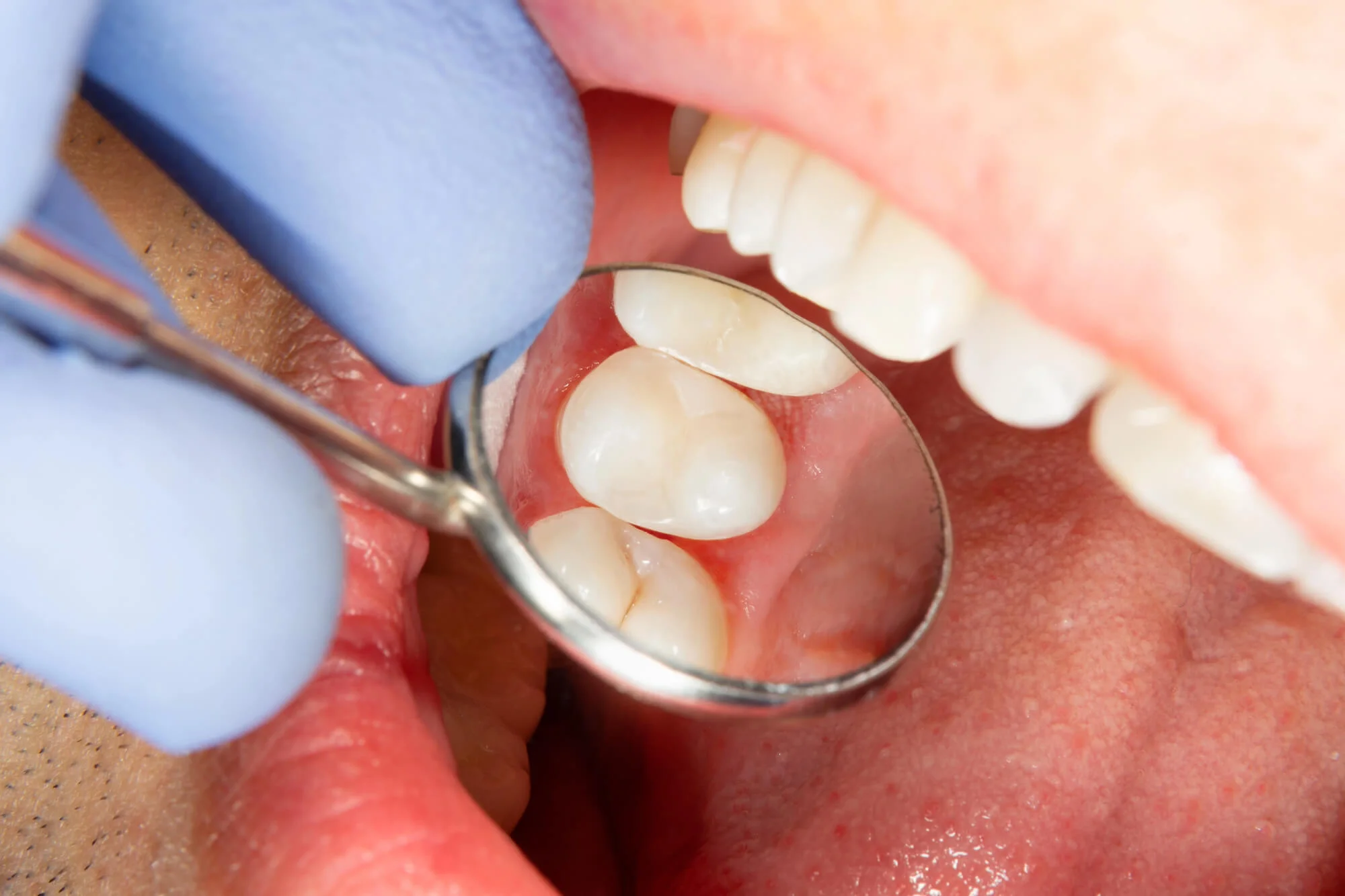Patient exam after dental fillings in Panama City, FL