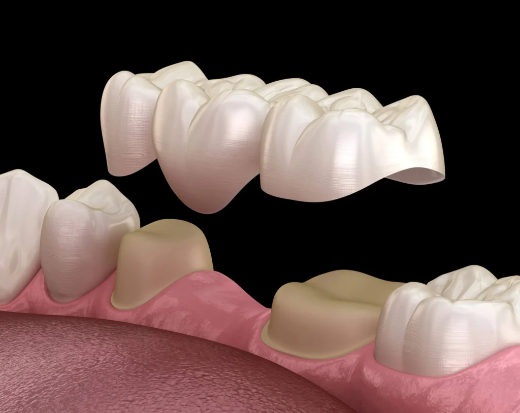 Illustration of dental bridges in Panama City, FL.