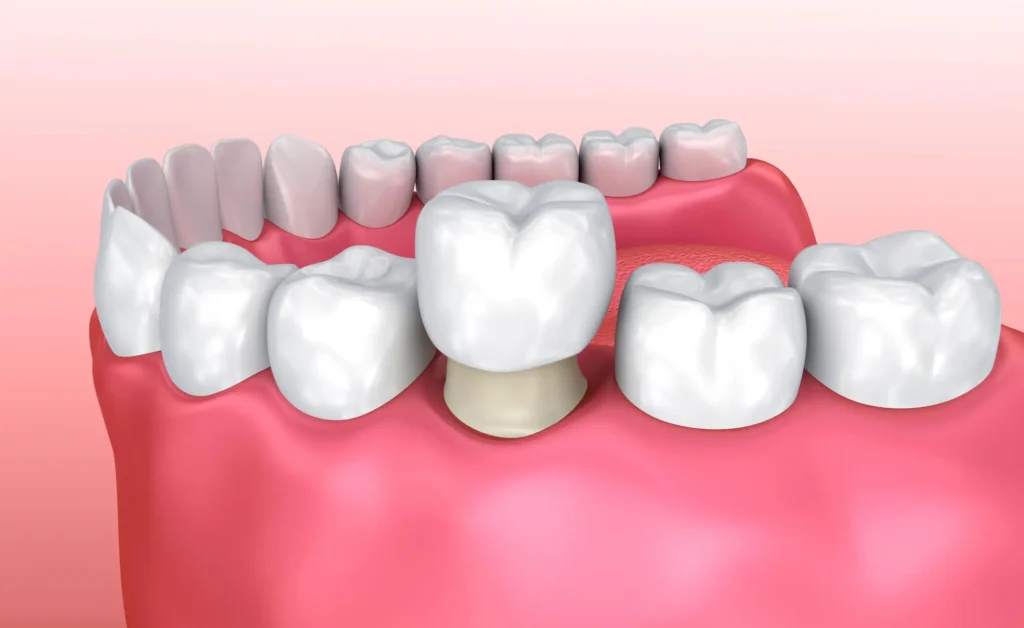 Dental-Crown-Installation-Process-for-Dental-Crowns-Panama-City-FL