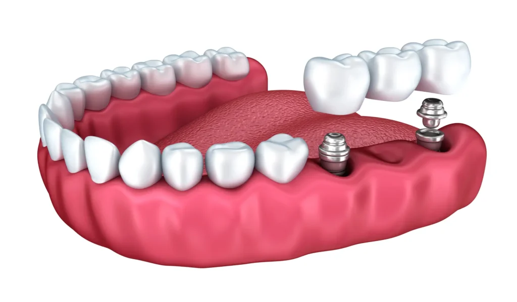 Dental Implants at Dentist in Bay County, FL