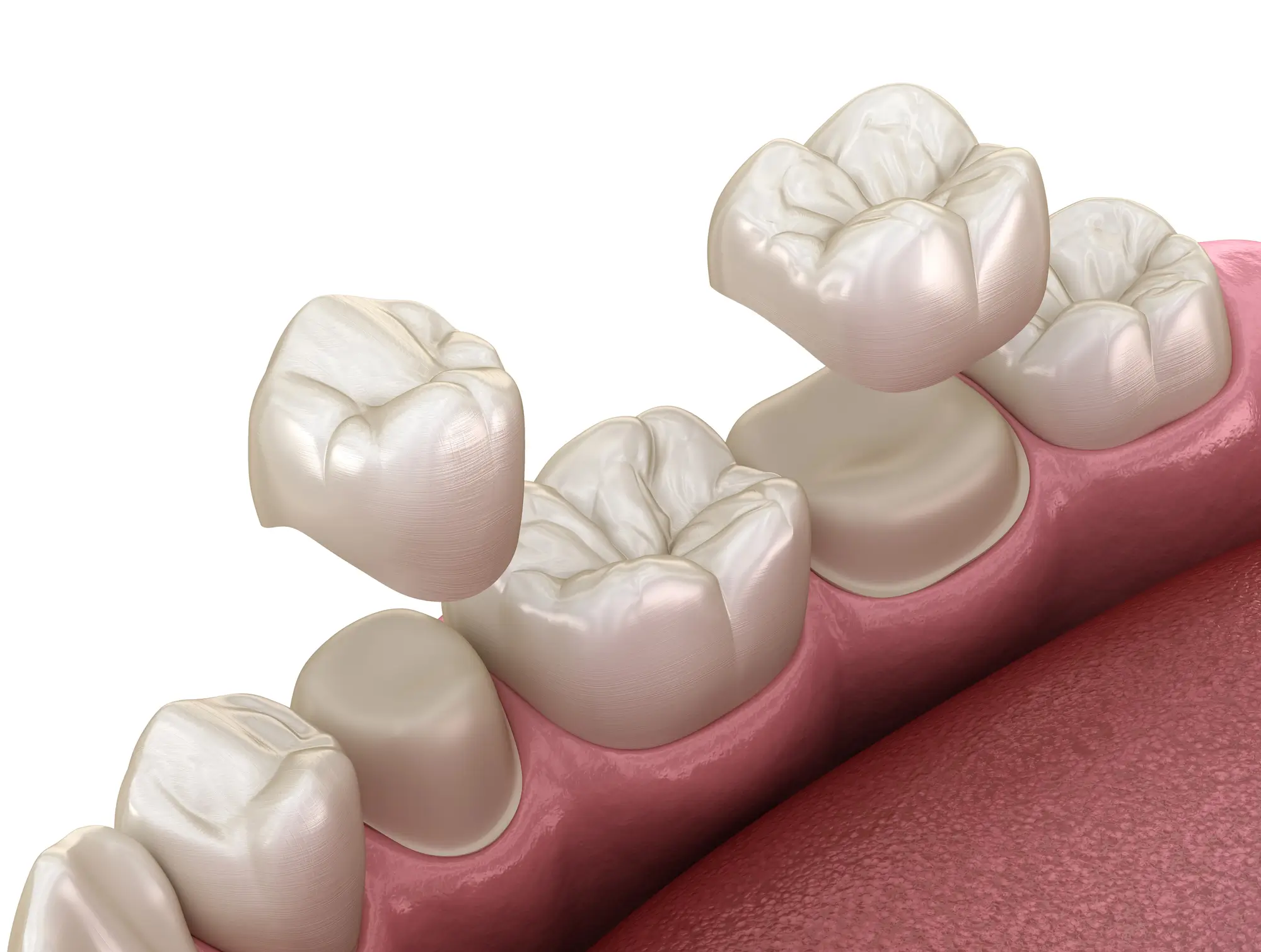 Porcelain tooth crowns in Panama City, FL placed on molars