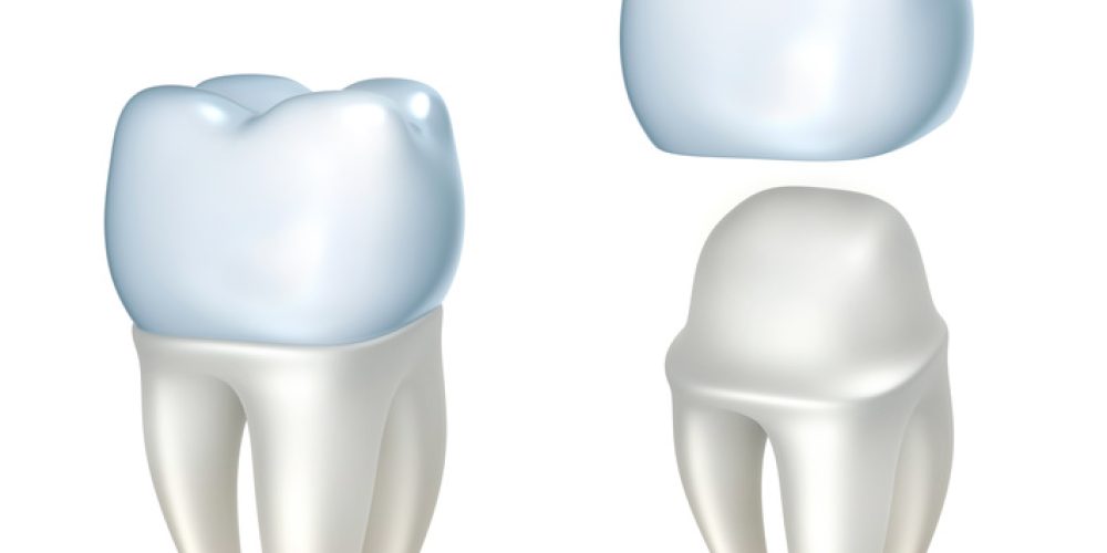 What Are The 4 Types Of Dental Crowns And How Can They Repair My Smile?