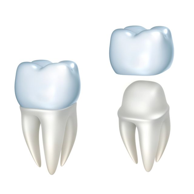 What Are The 4 Types Of Dental Crowns And How Can They Repair My Smile?