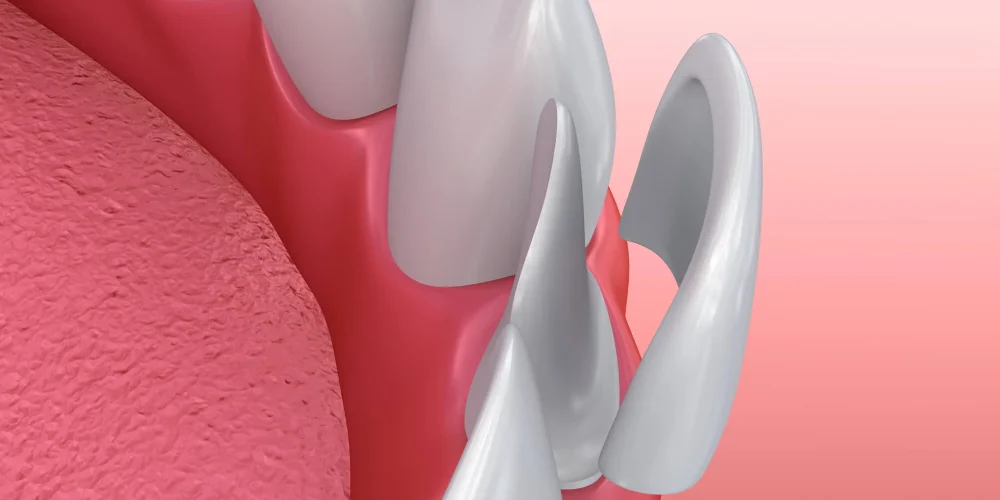 Get a Perfect Smile Fast With Custom Dental Veneers