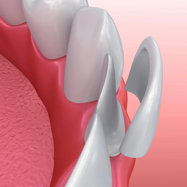 Get a Perfect Smile Fast With Custom Dental Veneers