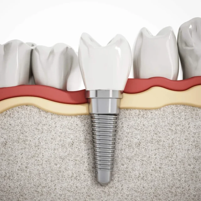 Are Dental Implants Painful? The Honest Truth 