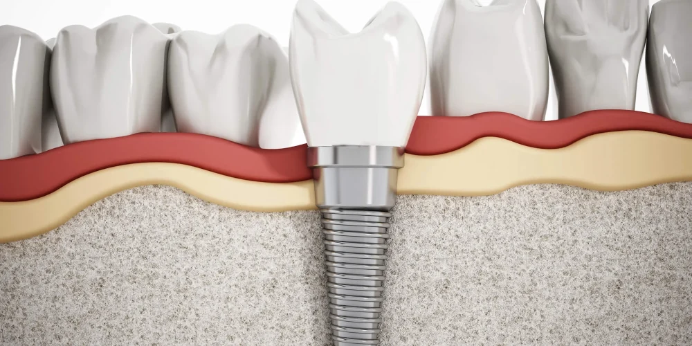 Are Dental Implants Painful? The Honest Truth 