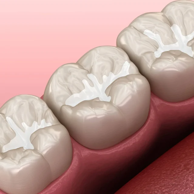 5 Common Myths About Dental Fillings Debunked
