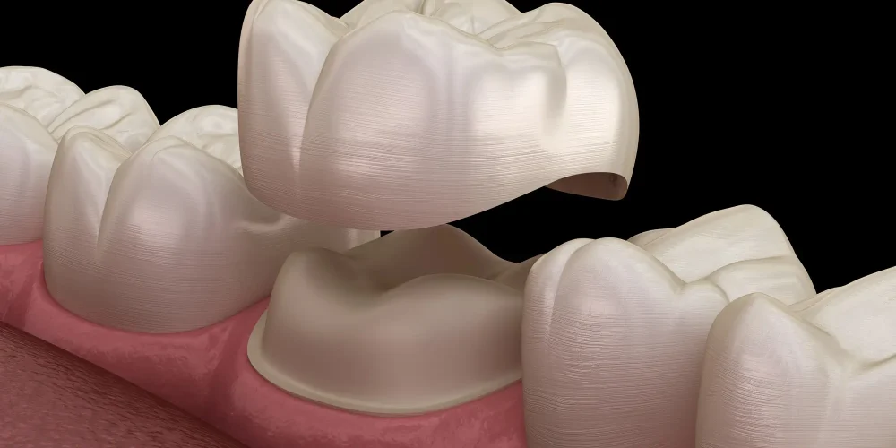 How Long a Dental Crown Actually Lasts (and How to Make It Last Longer) 